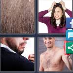Dandruff